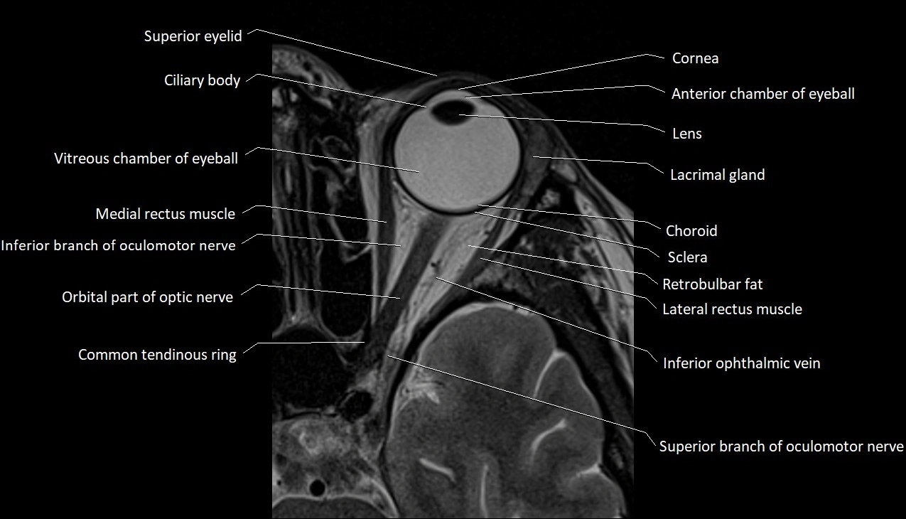 MRI Orbit axial cross sectional anatomy image 8.webp